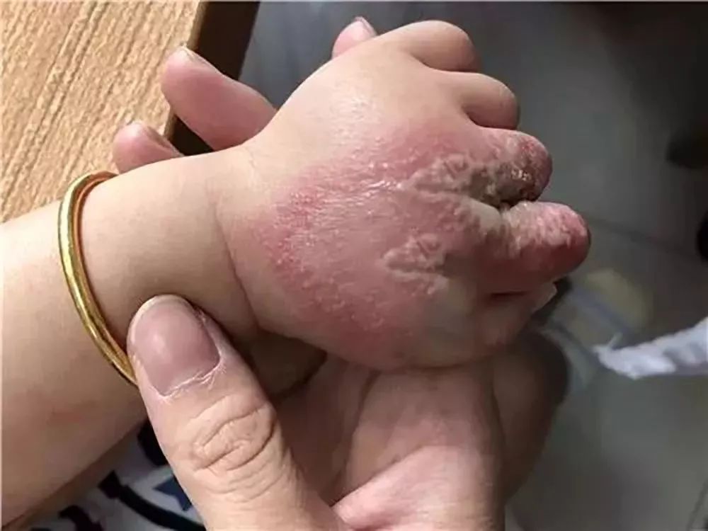 隱翅蟲的毒性有多強？體液比眼鏡蛇更毒，捕蠅草吸收它都會枯萎